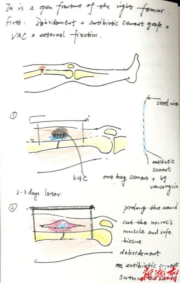长沙一骨科医生6年手绘上千幅手术方案，让患者“秒懂”