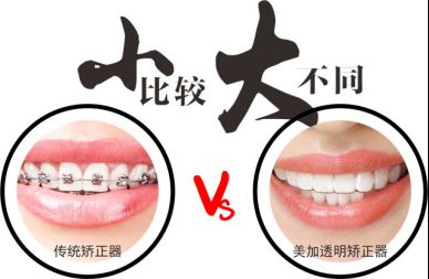 牙齿矫正大约花多少钱?成年人还能矫正吗?