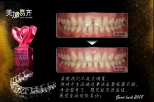 牙齿矫正大约花多少钱?成年人还能矫正吗?