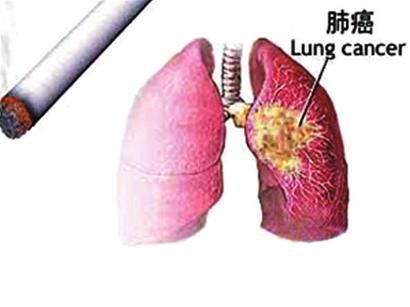 肺癌帮：抽烟与不抽烟的肺癌有何不同