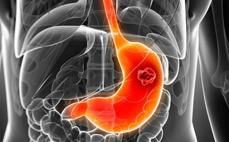 海外医疗，80%的患者检查确诊为胃癌中晚期，十类人需警惕胃癌