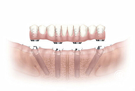 士卓曼种植体 口腔修复的美学首选