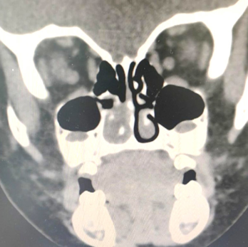 1岁女童鼻腔竟取出海绵宝宝