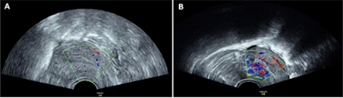 多次流产导致薄型子宫内膜难怀孕！这项特色技术帮她重获“希望”