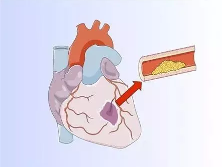 山西：心脏冠脉支架降价 最高降幅达69％