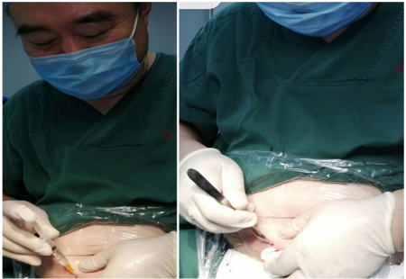 自己给自己做手术！菏泽这位医院院长是个“狠人”