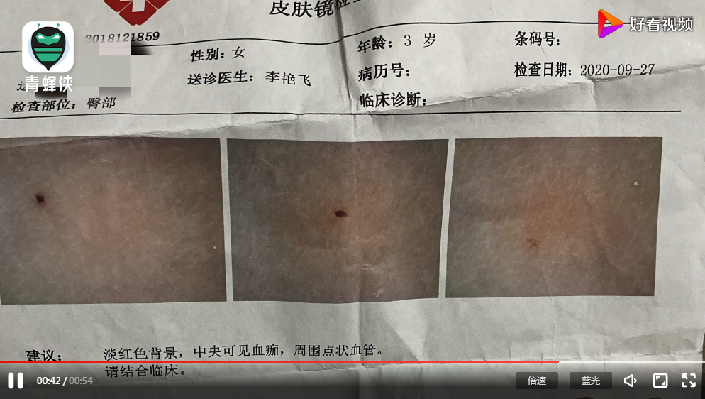 幼儿园孩子身上现针眼家长发声