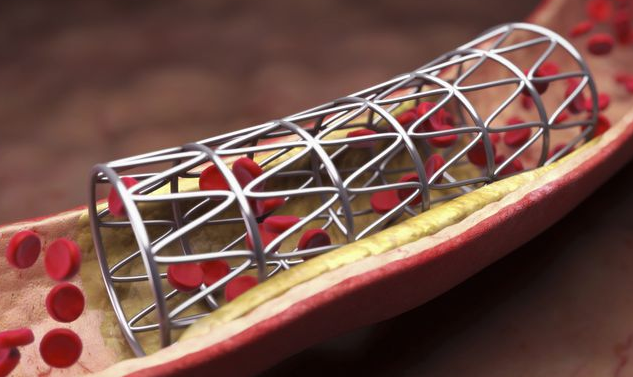 高值医用耗材治理的重要一步（人民时评）