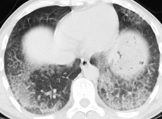 专家：肺部磨玻璃结节不一定等于肺癌