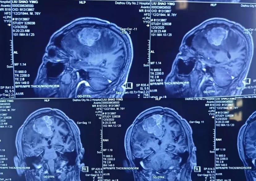 【医疗前沿】德州市第二人民医院—神经外科成功为高龄巨大脑膜瘤二期复发患者行手术治疗