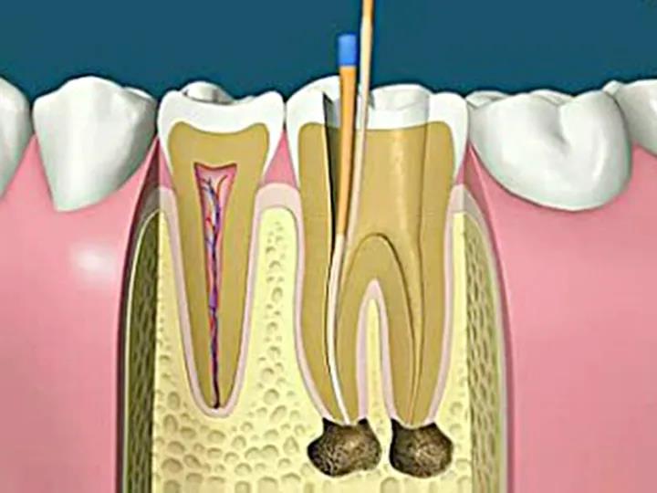 德州市中医院口腔科|"根管治疗"就是"抽牙神经"吗?