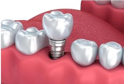 国家医保局：暂未考虑将种植牙纳入医保