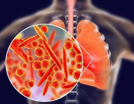 支原体肺炎导致的重症、危重症比例很低