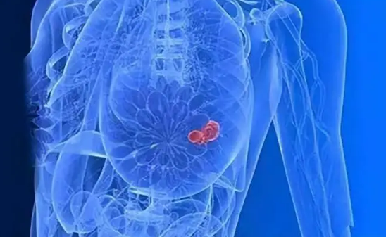 五年生存率超过80% 中国对乳腺癌说“不”
