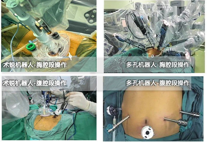 郑大一附院成功完成 12 例蛇形臂单孔机器人辅助食管癌根治术 —— 开创食管癌微创新纪元