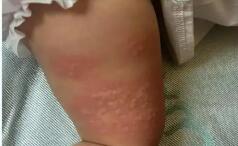 专家提醒：多重因素导致孩子过敏越来越常见