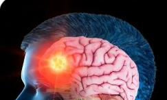 显效率77.26% 覆盖328县 我国基层癫痫防治取得扎实成效