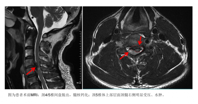  西南地区首例！四川泰康医院成功实施美敦力新型人工椎体手术 